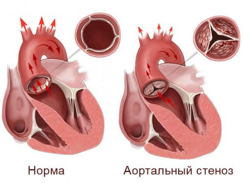 Стеноз аорты