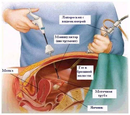 Лапароскопия