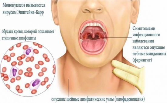 Симптомы инфекционного мононуклеоза