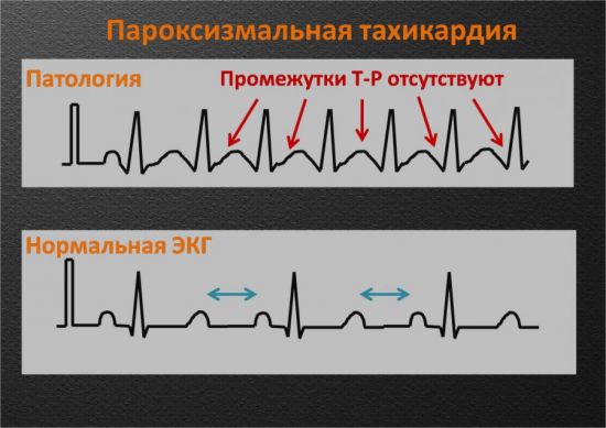 Пароксизмальная тахикардия