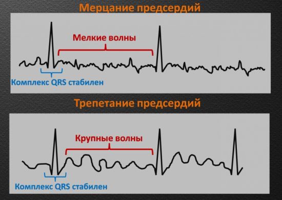 Мерцание и трепетание предсердий