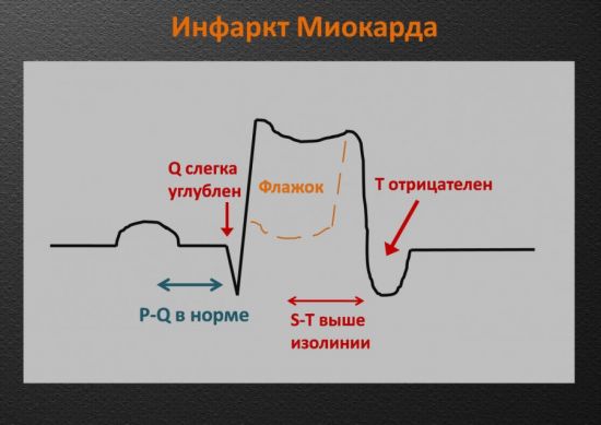 Инфаркт миокарда на ЭКГ