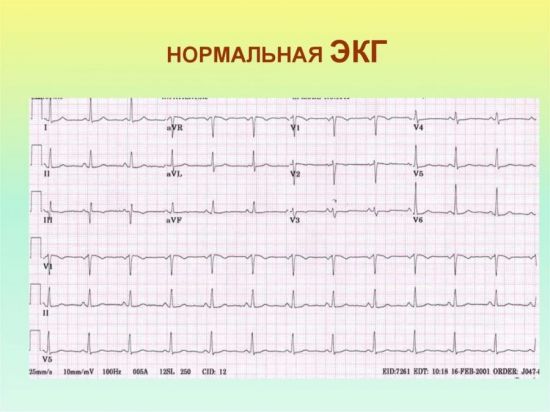 Нормальная ЭКГ