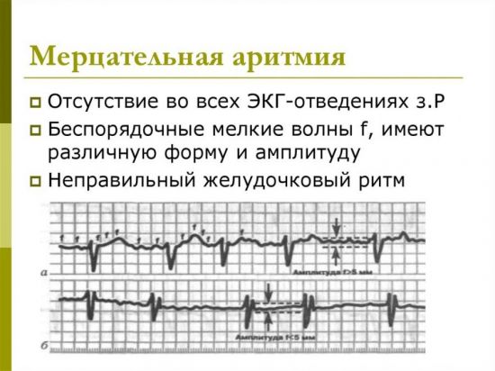 Мерцательная аритмия