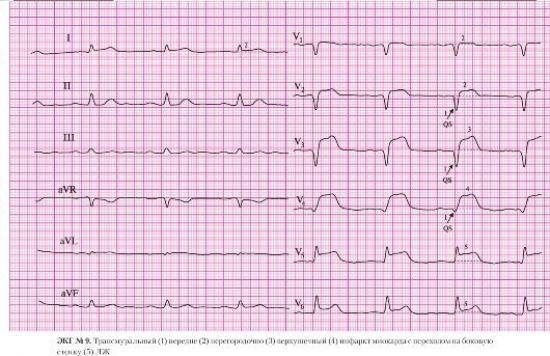 Инфаркт на ЭКГ