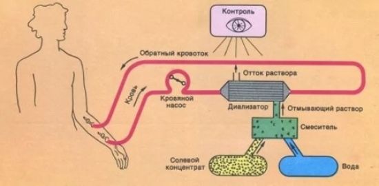 Принцип гемодиализа