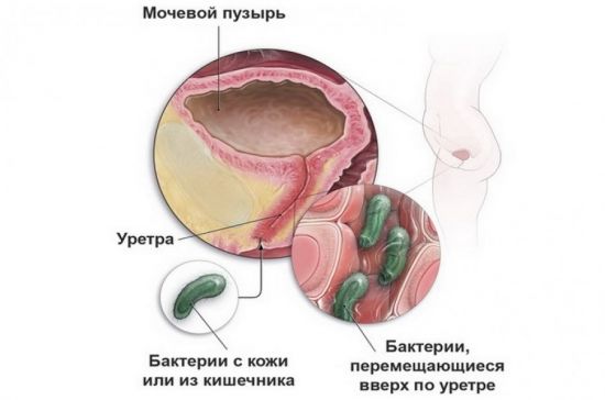 Бактерии из кишечника в мочу