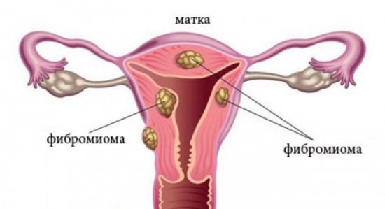 Фибромиома
