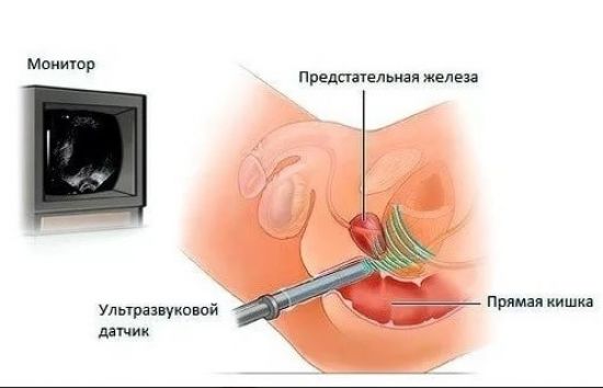 Трансректальное УЗИ