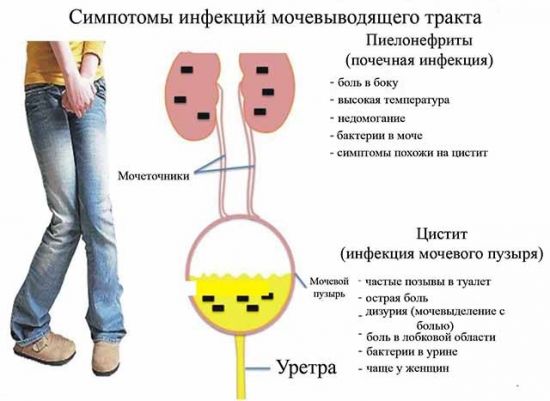 Симптомы инфекций мочевыделительной системы