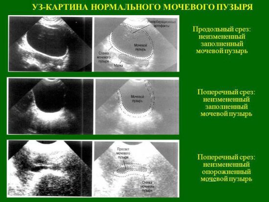 УЗИ мочевого пузыря в норме