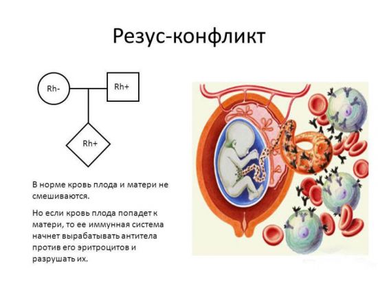 Резус-конфликт матери и плода