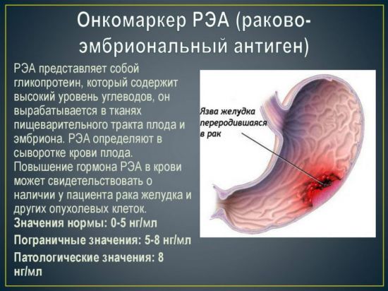 Онкомаркер РЭА