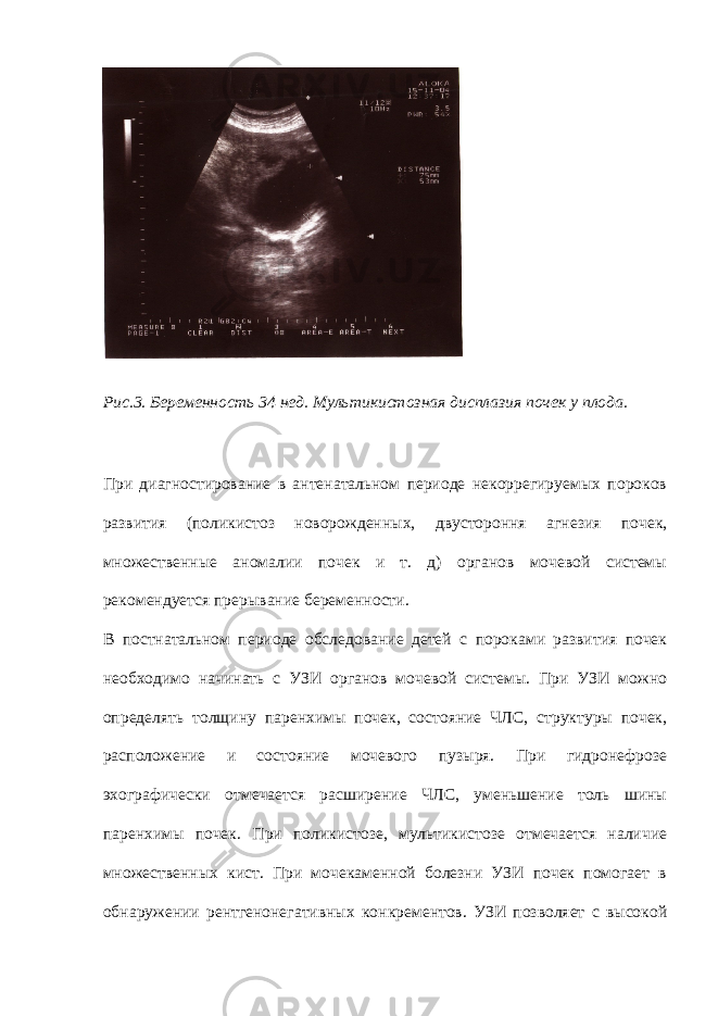 Пиелоэктазия почек у новорожденного