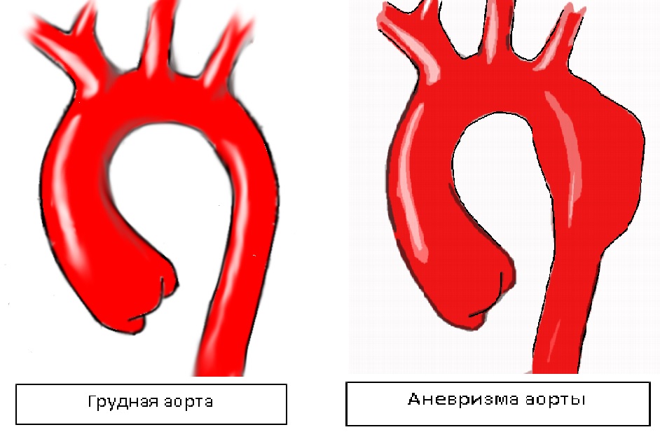 аневризма грудной аорты