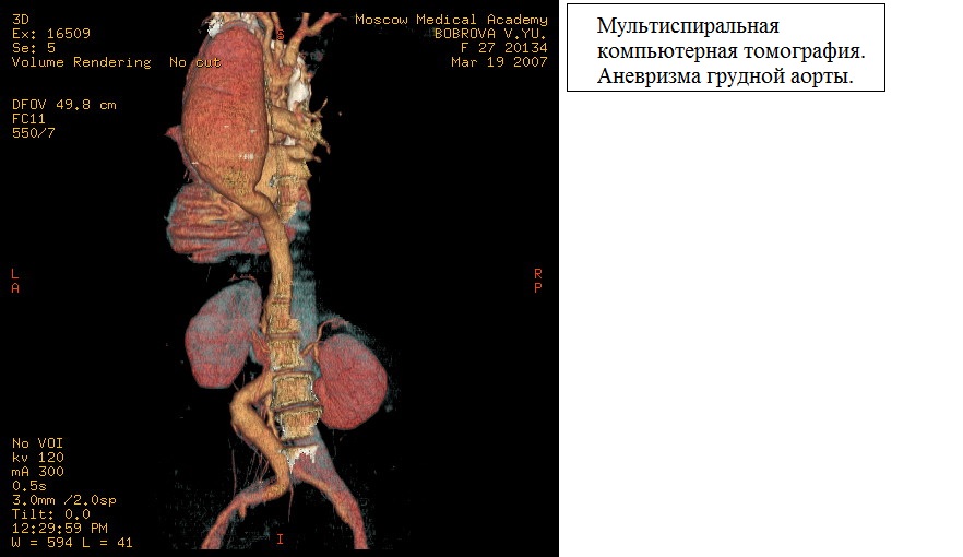 Аневризмы аорты фото