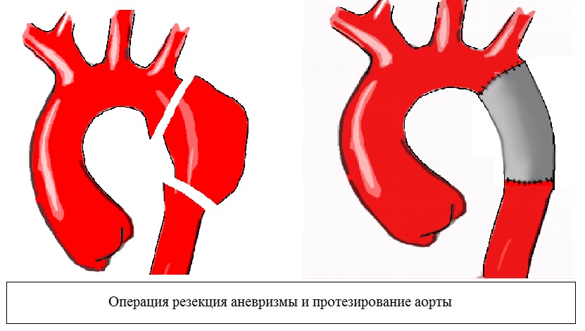 Операция резекции аневризмы и протезирование аорты