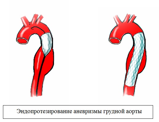 Эндопротезирование аневризмы грудной аорты