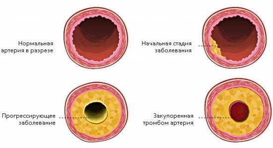 Стадии атеросклероза