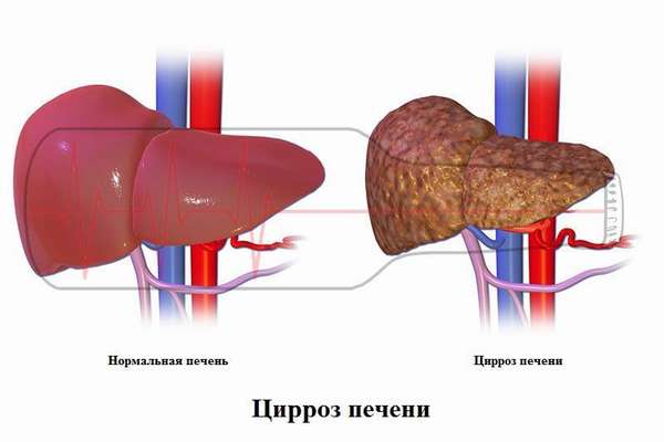 Цирроз печени: внешний вид