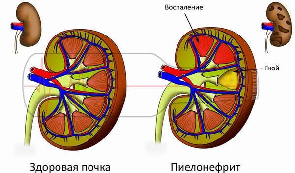 Признаки пиелонефрита и норма