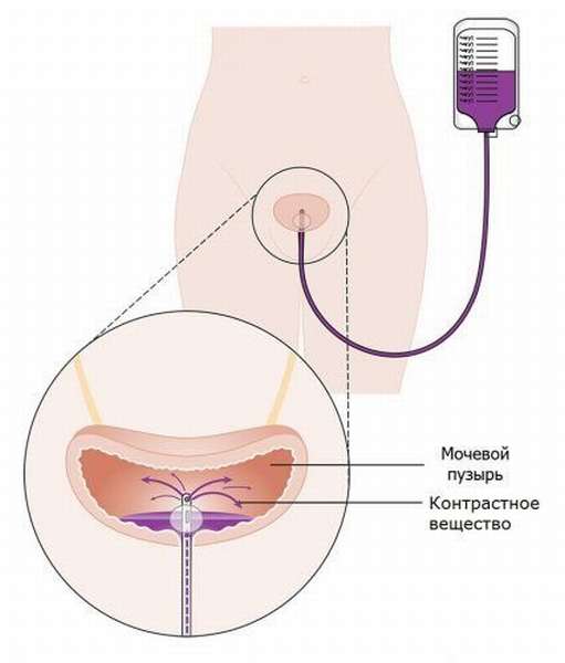 Катетеризация мочевого пузыря