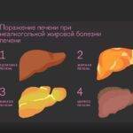 Жировая болезнь печени: что это такое и как ее лечить?