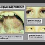 Лечение гепатита B у детей: препараты и народные средства