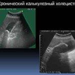 Холецистит калькулезный, острый и хронический: профилактика, диагностика, лечение