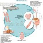 Описторхоз: что это такое у взрослого человека, симптомы и лечение