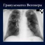 Симптомы Гранулематоза Вегенера и прогноз жизни