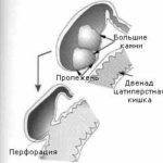 Осложнения и последствия желчнокаменной болезни