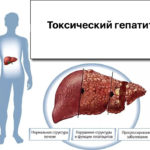 Что такое гепатит: симптомы и лечение заболевания в разной форме