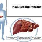 Можно ли вылечить токсический гепатит в хронической и острой форме?