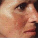 Пигментные пятна на лице при заболеваниях печени