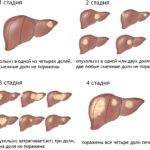 Симптомы и лечение онкологии печени