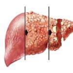 Симптомы и лечение онкологии печени
