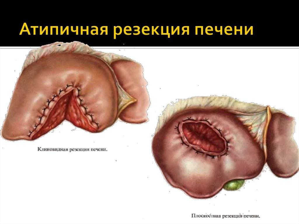 Операция на печени: подготовка, виды, последствия