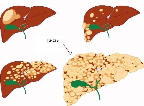 Поликистоз печени: что это и сколько живут с таким диагнозом?