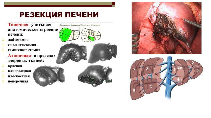 Резекция печени: что это такое, как проводится и когда показана операция?