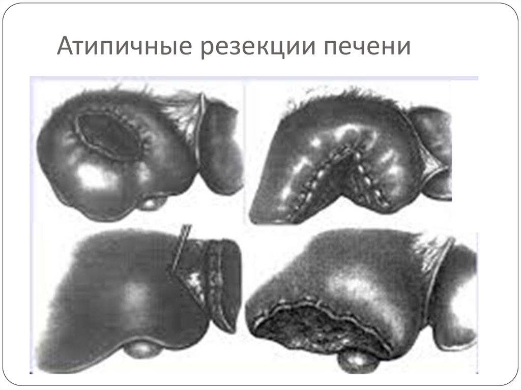 Резекция печени: что это такое, как проводится и когда показана операция?