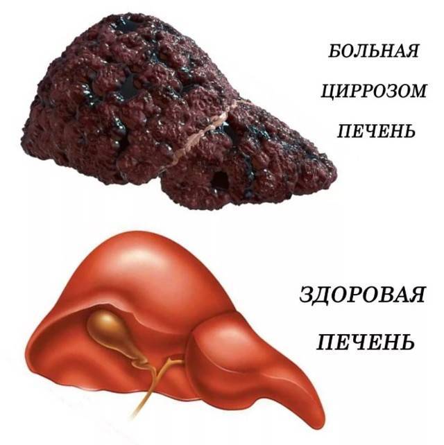 Как распознать и диагностировать цирроз печени?