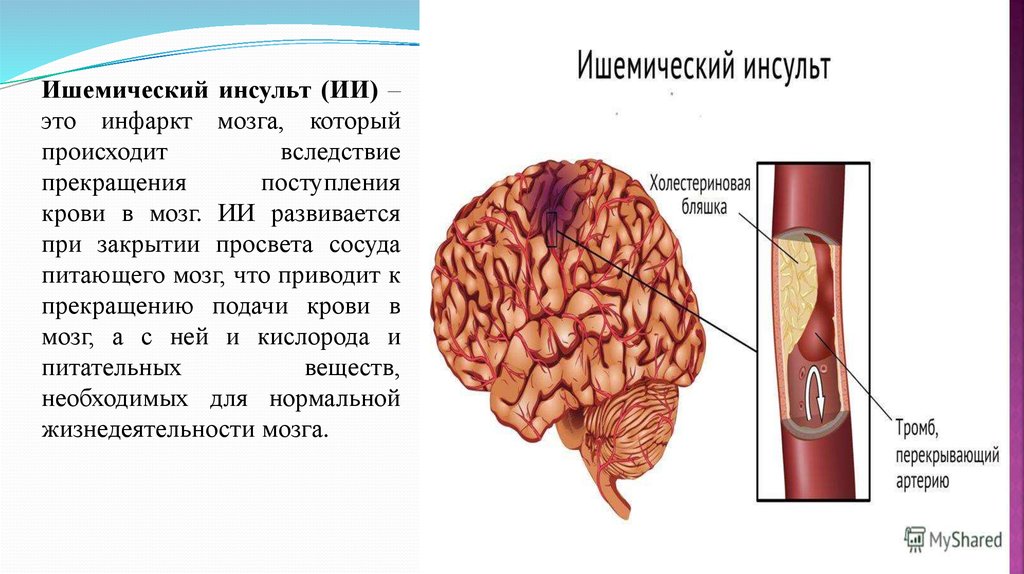 Ишемический инсульт что это такое. Ишемический инсульт патологическая анатомия. Ишемический инсульт развивается. Ишемический инсульт (инфаркт мозга).