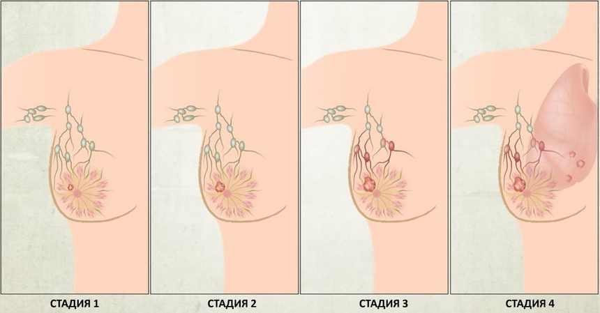Стадии рака груди: 1, 2, 3 и 4 стадия