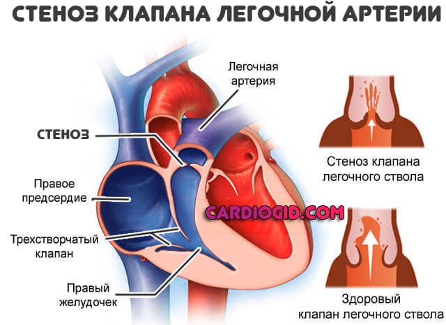 стеноз-клапана-легочной-артерии