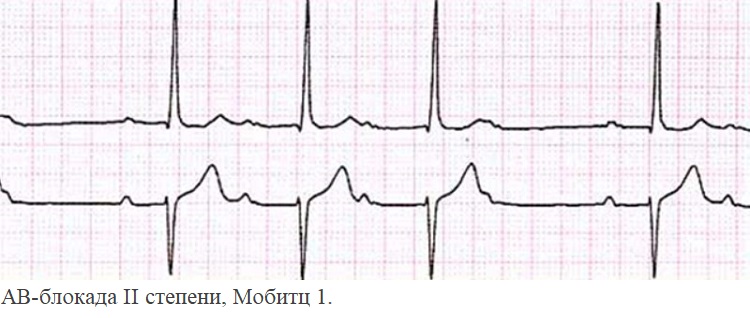 АВ-блокада II степени, Мобитц 1.