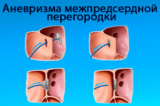 Аневризма межпредсердной перегородки