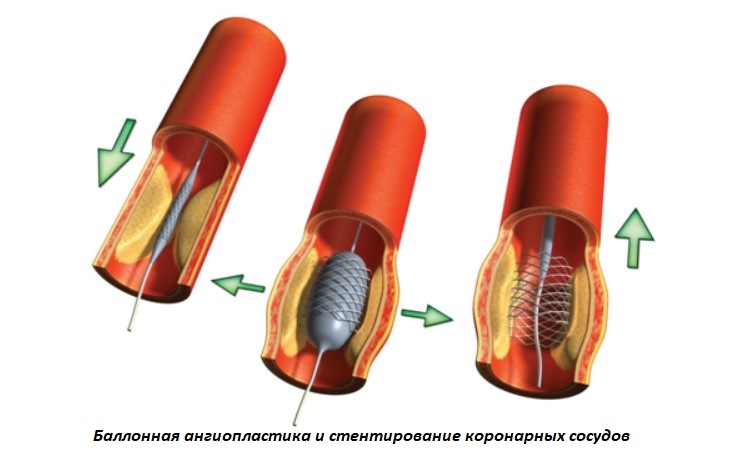 Баллонная ангиопластика и стентирование коронарных сосудов