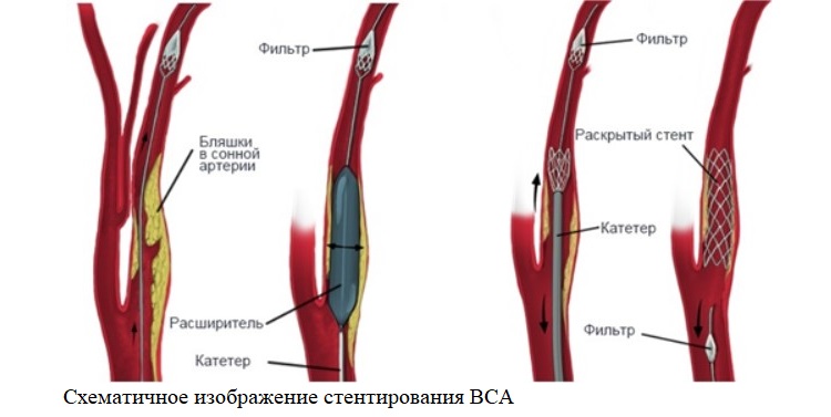 Схематичное изображение стентирования ВСА