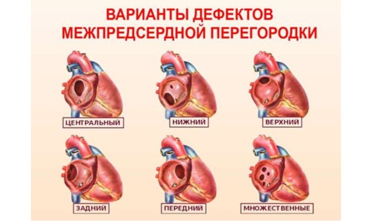 Варианты дефектов